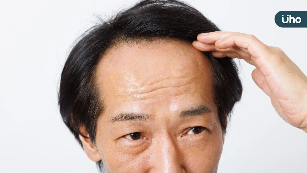 落髮不一定只和荷爾蒙有關 醫毛囊微環境失衡也可能讓髮量變少